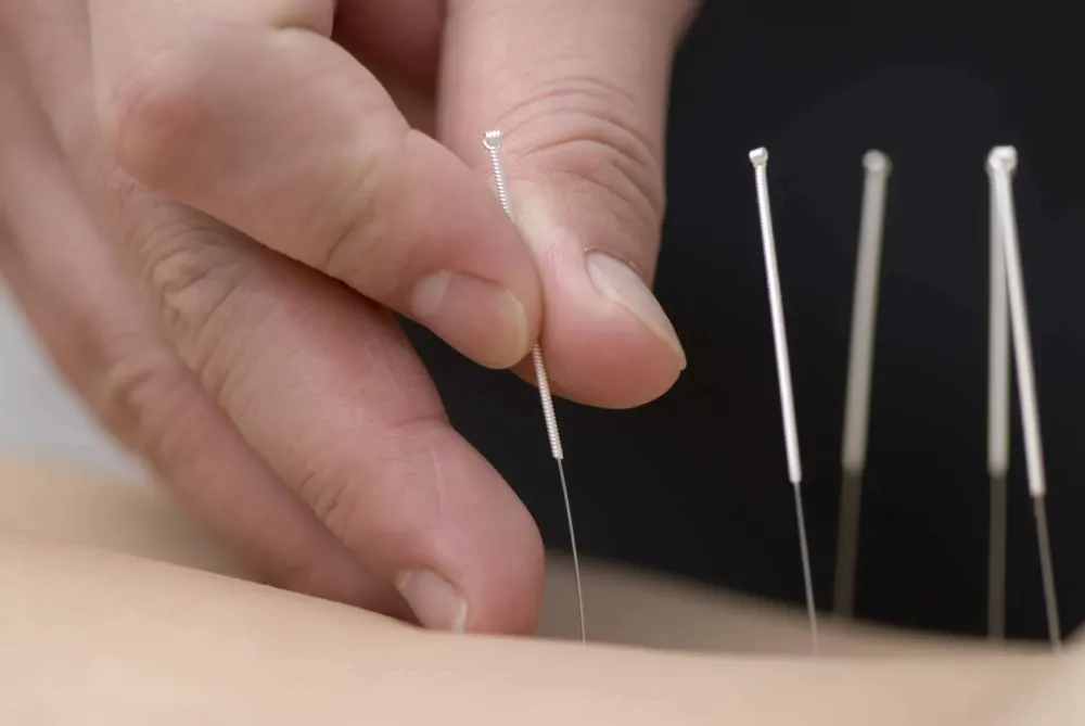 acupuncture (6)